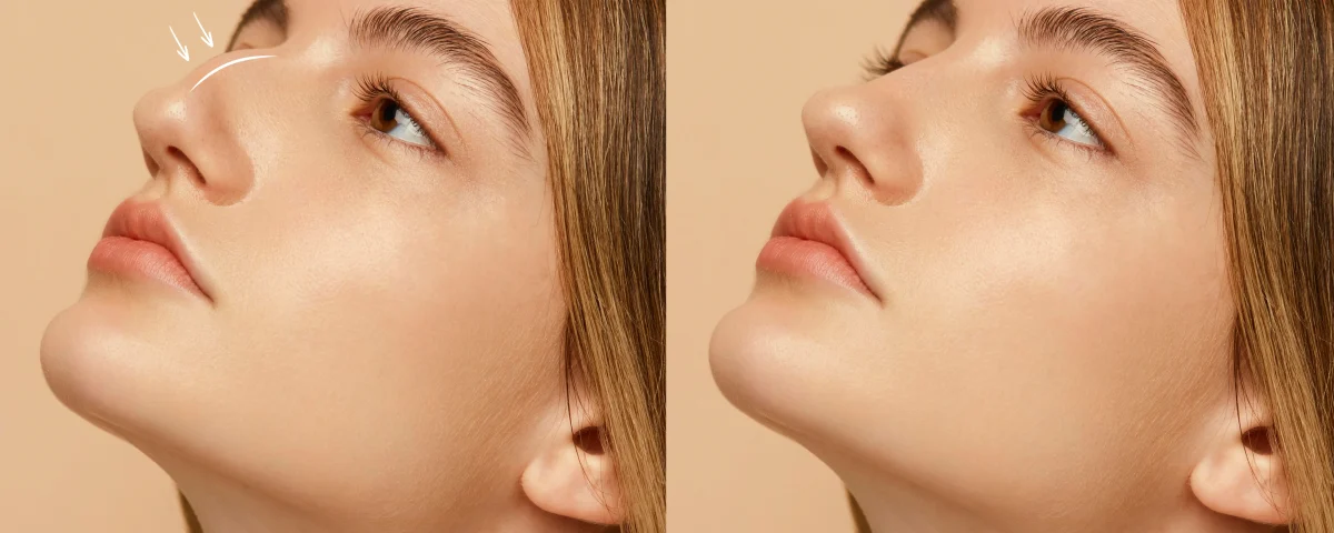 Rhinoplasty